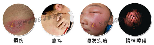 警惕 皮炎可能诱发其他疾病
